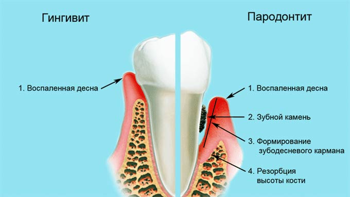 Оценка эффективности клинического применения пародонтального геля «ГЛИКОДЕНТ» при травматических поражениях тканей пародонта. Часть 1. 